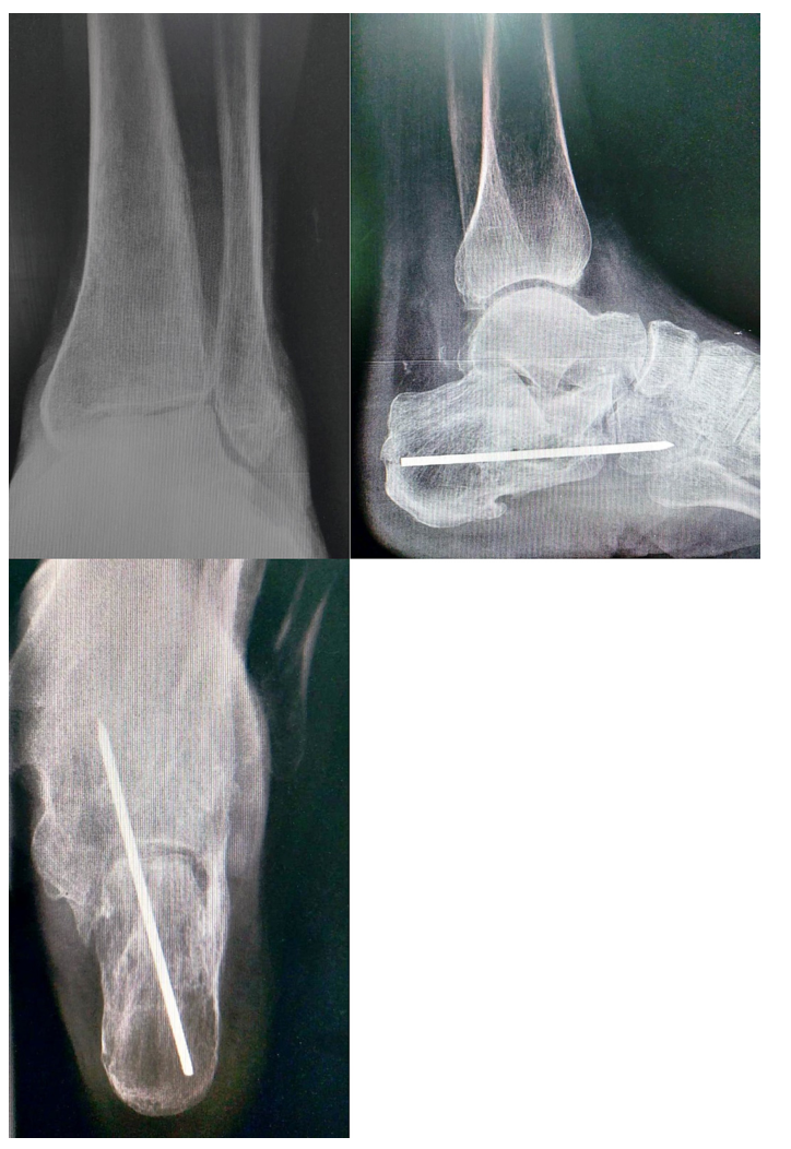 Trauma Case Rep：外侧距下关节脱位合并跟骨骨折和外踝骨折的罕见病例 