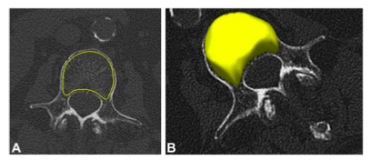 academic radiology：如何对<font color="red">脊柱</font>急性闭合性骨折患者进行准确诊断？