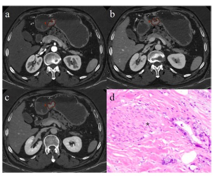 European Radiology：光谱CT，实现<font color="red">胃癌</font>神经周围浸润的术前预测！