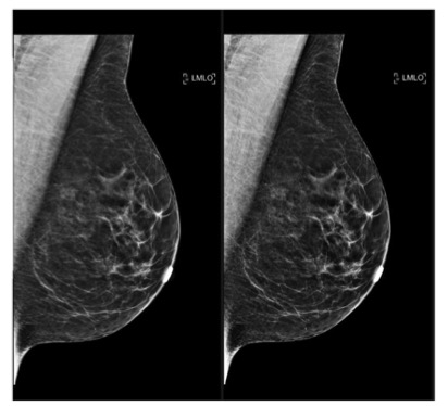 academic radiology：如何应用压缩乳腺钼靶图像进行更规范的放射学培训？