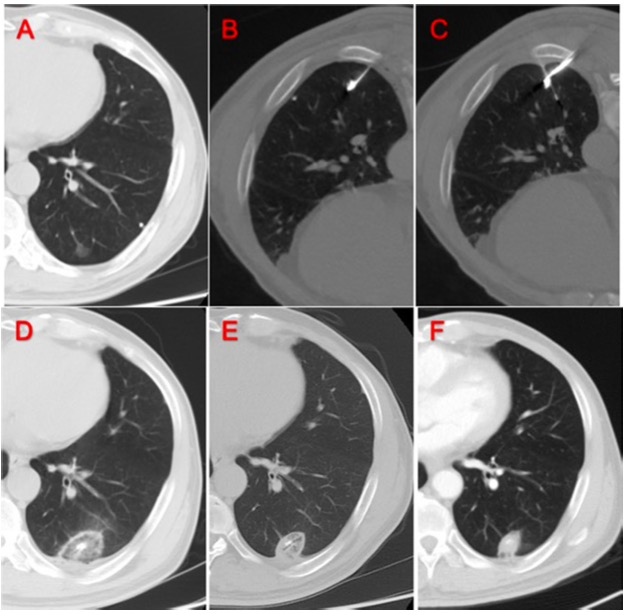 European Radiology：利用碘油定位，促进肺GGO的联合活检和经皮微波消融！