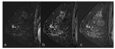 Academic Radiology：乳腺乳头状瘤MRI非肿块强化的良恶性鉴别诊断