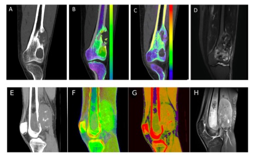 Academic radiology：双能CT技术对原发性恶性骨肿瘤骨髓浸润的诊断价值！