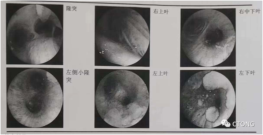 中國胸部腫瘤大會(huì)診病例（6）：<font color="red">IIB</font>期肺鱗癌的綜合治療