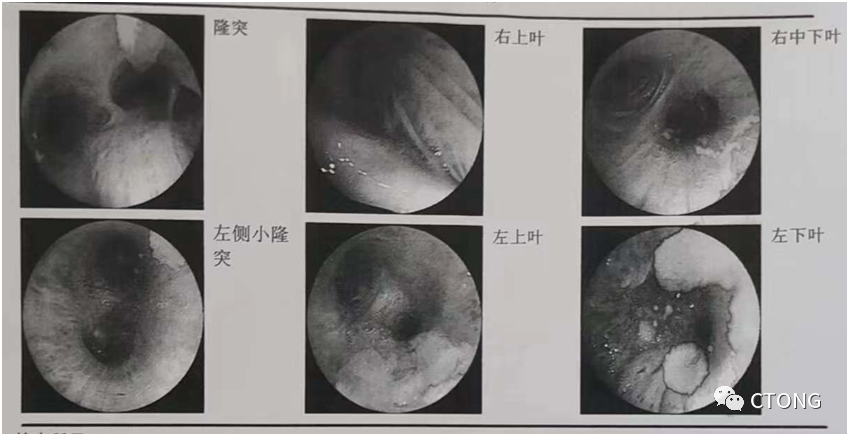 中国胸部肿瘤大会诊病例（6）：<font color="red">IIB</font>期肺鳞癌的综合治疗