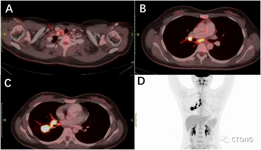 中国<font color="red">胸部</font>肿瘤大会诊病例（10）：局部晚期ALK融合肺腺癌诱导治疗联合根治术后的治疗选择