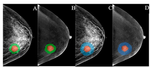 Academic Radiology：增强钼靶放射<font color="red">组</font><font color="red">学</font>模型在预测乳腺癌患者腋窝淋巴结转移方面的应用