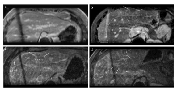 European Radiology：三维高分辨率MR晚期钆增强实现Fontan循环肝纤维化的无创评估