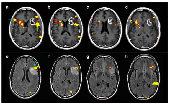 European Radiology：肿瘤遗传学、病理和<font color="red">定位</font>对脑肿瘤患者语言重组功能MRI的影响