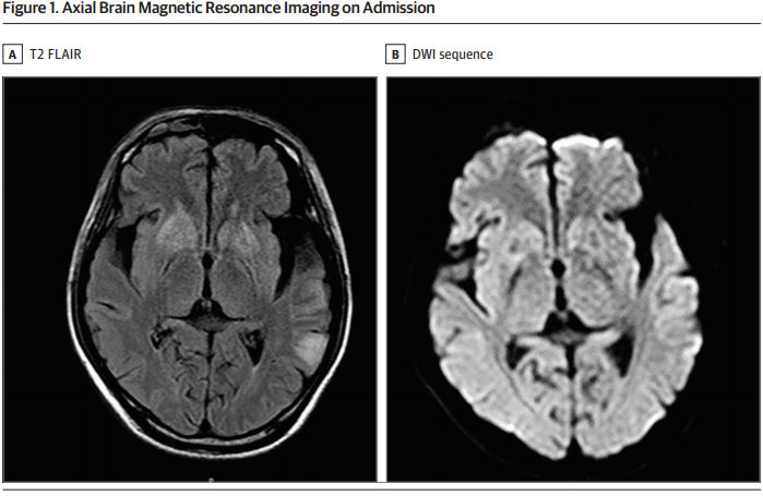 《JAMA Neurology》图片<font color="red">病例</font><font color="red">报道</font>：迟发性甲基丙二酸血症的可逆性皮质和基底神经节损害