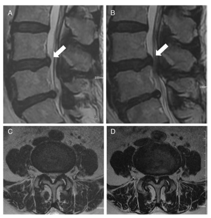European Radiology:新型轴位负荷MRI设备对腰椎管狭窄的诊断价值