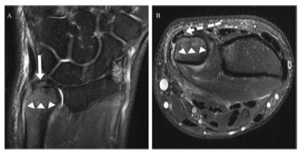 European Radiology:腕关节MRI诊断TFCC撕裂的影像学表现