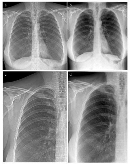 European Radiology:暗场胸部X线成像图像诊断质量的相关研究