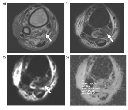 European Radiology：弥散加权MR成像和ADC测量在糖尿病患者踝关节DWI研究的应用