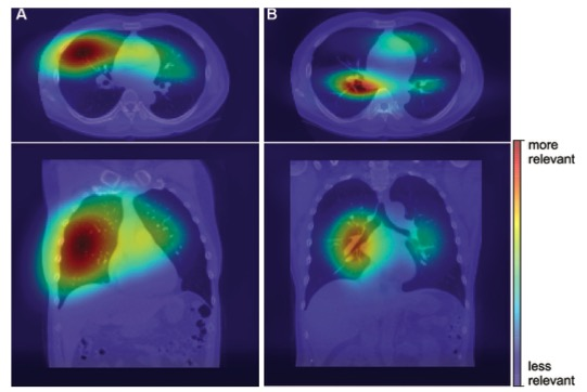 Radiology：基于深度学习的胸部CT肺功能预测方法