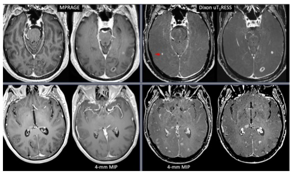 Investigative Radiology：如何改善3T MRI的脑肿瘤显示及诊断？