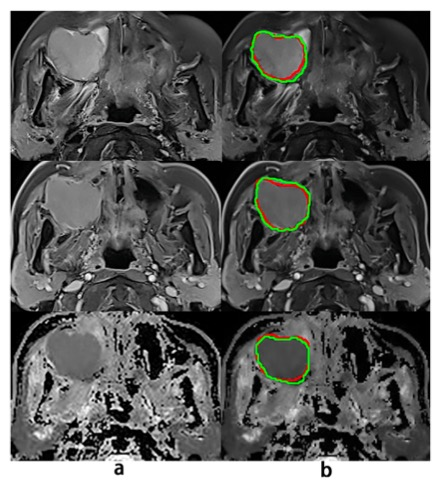 Academic Radiology：利用深度学习和多<font color="red">参数</font>MRI放射组学<font color="red">预测</font>晚期鼻窦鳞癌的早期复发