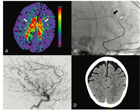 Radiology：孤立性大脑前动脉卒中的取栓与药物治疗评估