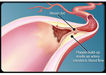 NEJM：药物洗脱可吸收支架与血管成形术治疗腘下动脉疾病