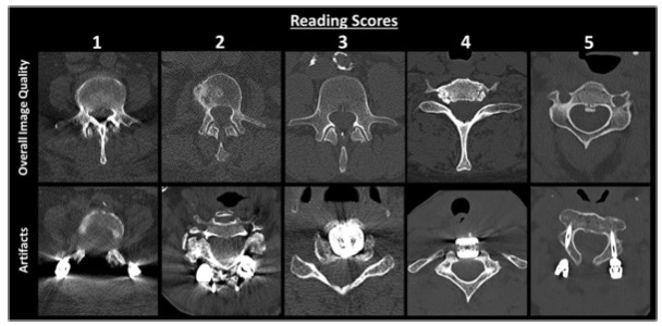 European Radiology:脊柱的光子计数CT对诊断可信度和<font color="red">辐射剂量</font>的影响