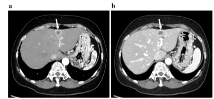 Eur J Radiol：利用深度学习提高胰腺癌的双能CT图像质量