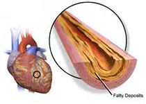 JAHA：术中炎症激活与早期冠状动脉支架血栓形成风险增加的关系