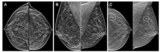 Radiology：超声和数字乳腺断层成像在乳腺局灶性病变检测中的应用
