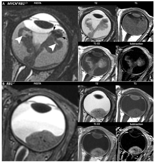 Radiology：MYCN扩增RB1野生型视网膜母细胞瘤的MRI特征