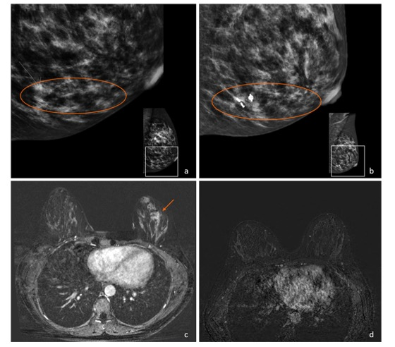 European Radiology：究竟该如何利用影像学对新辅助系统治疗后的乳腺癌患者进行准确评估？