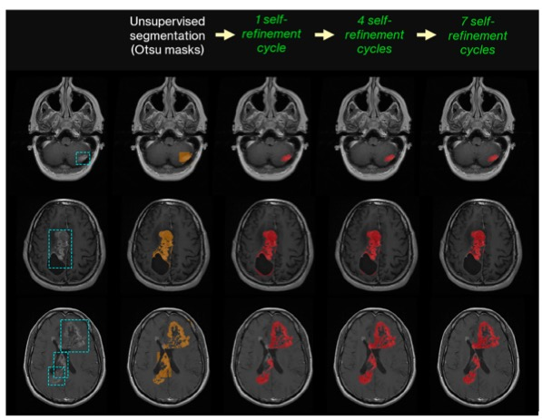 European Radiology：如何实现<font color="red">颅脑</font>MRI<font color="red">肿瘤</font>的自动分割？