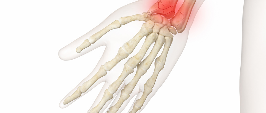 Arthritis Rheumatol：急性焦磷酸盐关节病患者是否有较高的骨折风险？