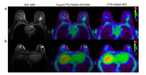 European Radiology：ER +乳腺癌缺氧和血管功能的PET/MRI评估