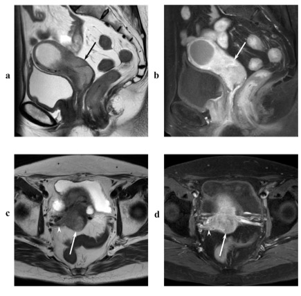 Eur J Radiol：哪些MRI特征可预测子宫颈腺癌患者的组织学亚型？