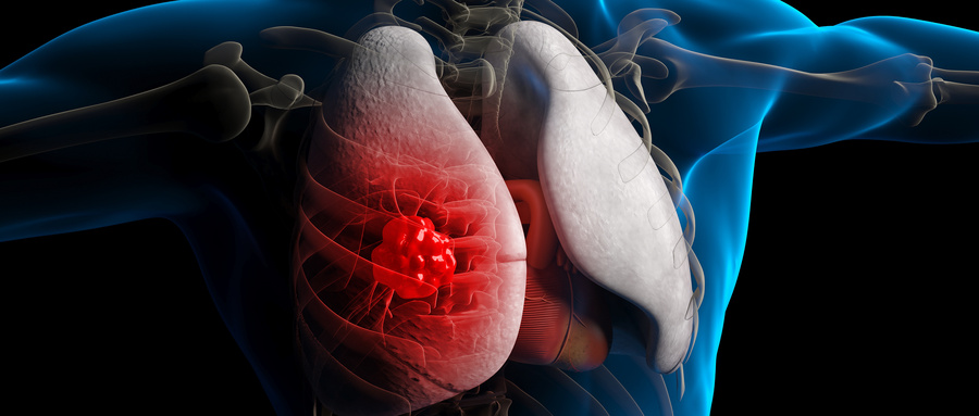 BRIT J SPORT MED：57652名瑞典男性的心肺健康变化与前列腺癌发病率和死亡率之间的关联