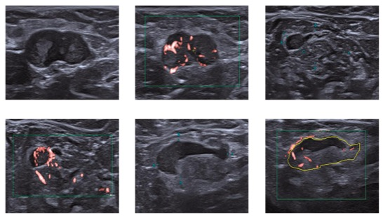 Eur J Radiol：如何利用影像学工具准确预测乳腺癌腋窝淋巴结转移