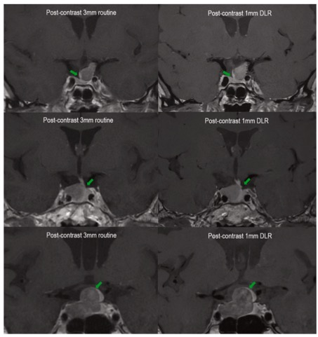 Eur J Radiol：基于深度学习的图像重建提高了垂体腺瘤的影像学划分