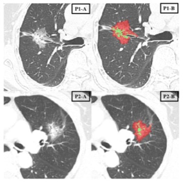 European Radiology：<font color="red">肺</font>腺癌的深度学习预后预测