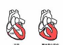 Eur Heart J：经导管或手术主动脉瓣植入术结局比较