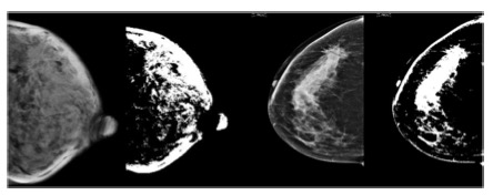 European Radiology：深度学习在乳腺钼靶中检测乳腺癌的价值