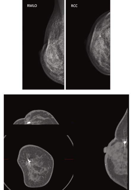 Eur J Radiol：有乳腺癌病史患者的专用乳腺计算机<font color="red">断层扫描</font>检查