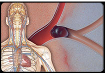 Heart：高风险非ST段抬高急性冠状动脉综合征患者早期有创策略