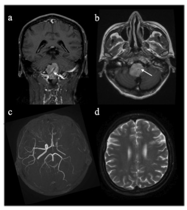 European Radiology：组织细胞肿瘤累及中枢神经系统的神经影像学特征比较