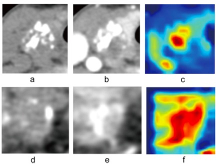 European Radiology：基于CT人工智能的甲状腺乳头状癌<font color="red">颈部</font>淋巴结转移预测