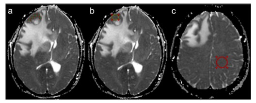 European Radiology:<font color="red">原发性</font>中枢神经系统淋巴瘤和胶质母细胞瘤的多参数MR分析