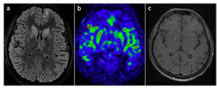 European Radiology：原发性<font color="red">噬</font><font color="red">血细胞</font><font color="red">性</font><font color="red">淋巴</font><font color="red">组织细胞</font><font color="red">增多</font><font color="red">症</font>的神经影像学表现谱