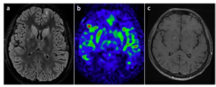 European Radiology：原发性噬血细胞性淋巴组织细胞增多症的神经影像学表现谱