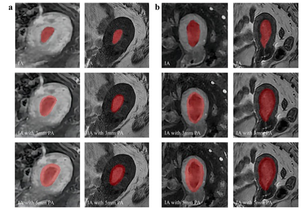 European Radiology：基于MR的放射组学模型在预测<font color="red">子宫内膜</font>癌患者复发风险方面的价值