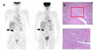 European Radiology：高[18F]FDG摄取是否意味着结肠癌患者的预后不良?