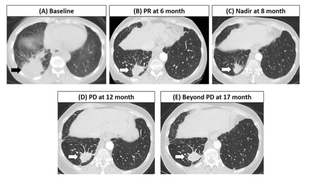 European Radiology:pembrolizumab联合化疗治疗的晚期非小细胞肺癌的价值及评估