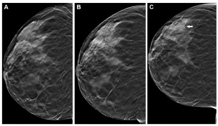Radiology:数字乳腺断层成像与钼靶成像在乳腺癌监测中的应用